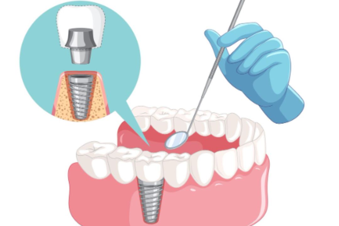 how much does a single tooth implant cost